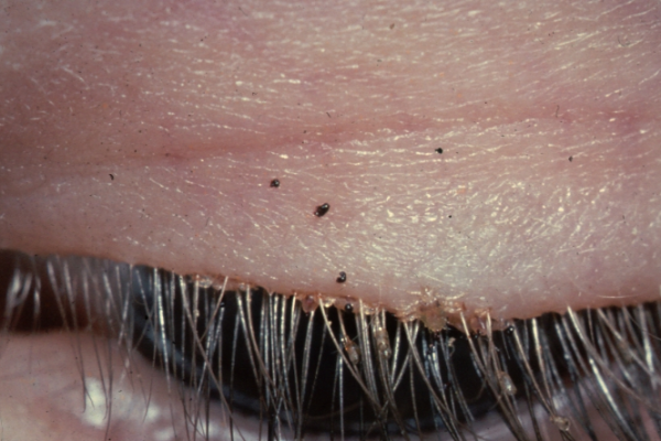 Pubic lice in eyelashes