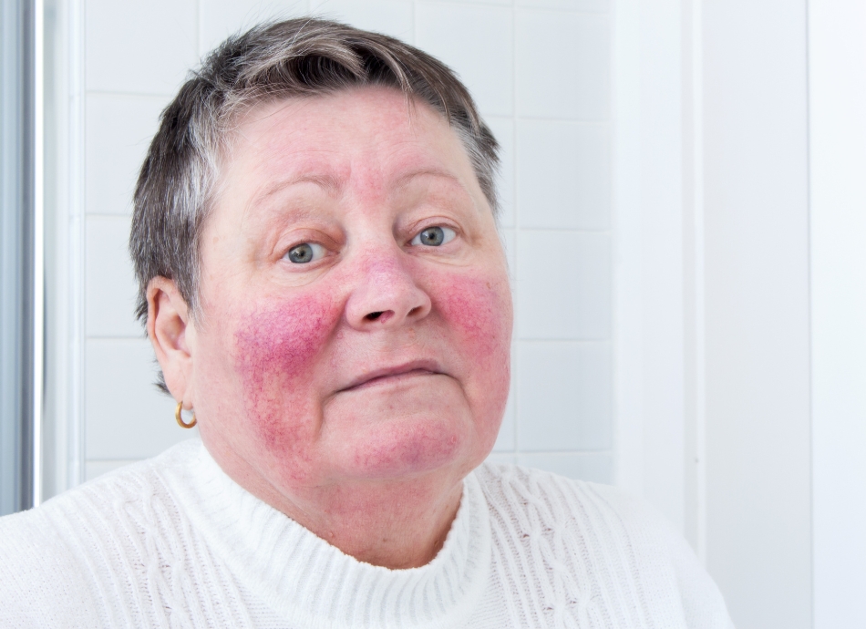 Rosacea on woman's face