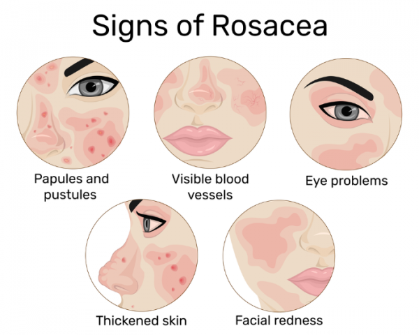 Different signs of rosacea