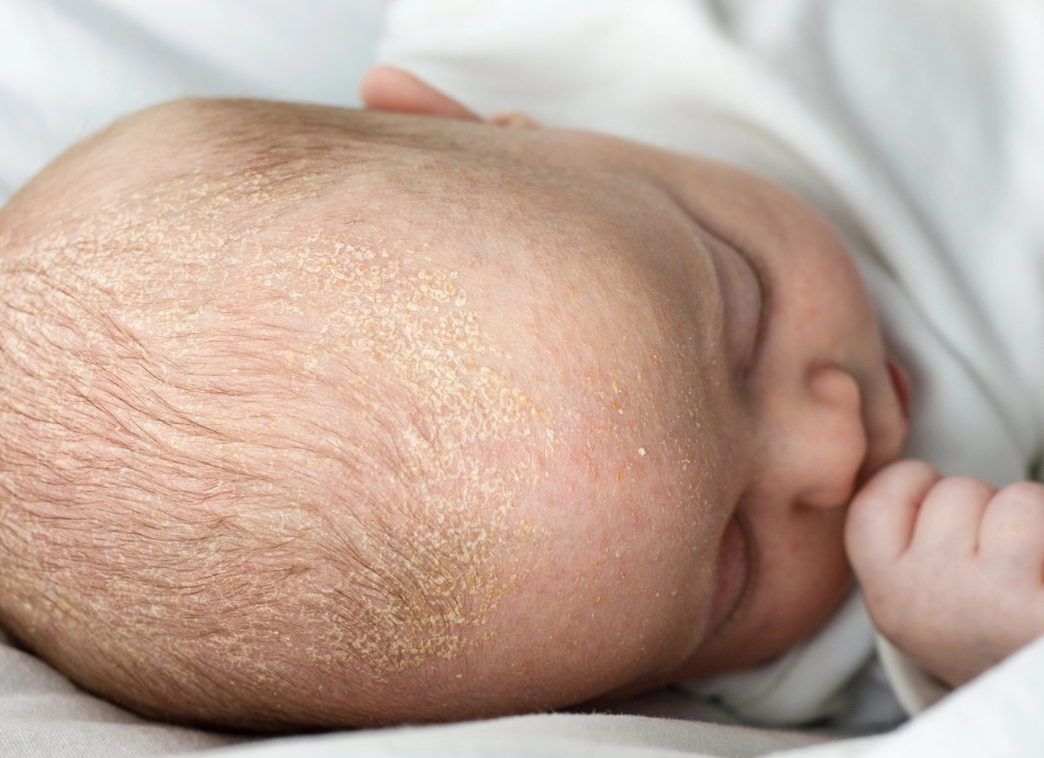 Seborrhoeic dermatitis_cradle cap