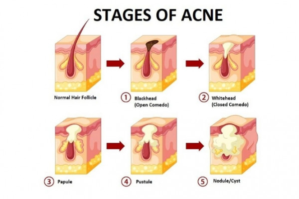Different stages of acne