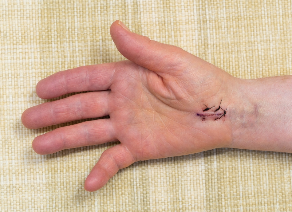Stitches in hand