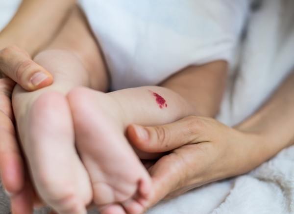 Strawberry naevus on baby's leg
