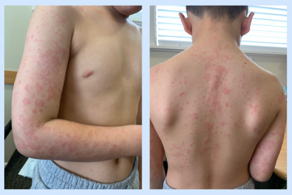 Photo of boy's back and arm with hives