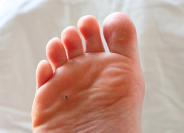 Verruca on the bottom of a foot