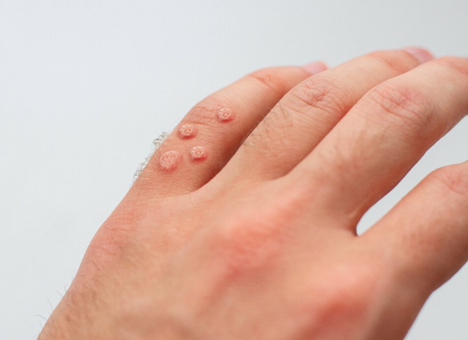 Warts on fingers of left hand