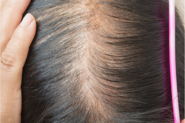 Woman's scalp showing thinning hair 