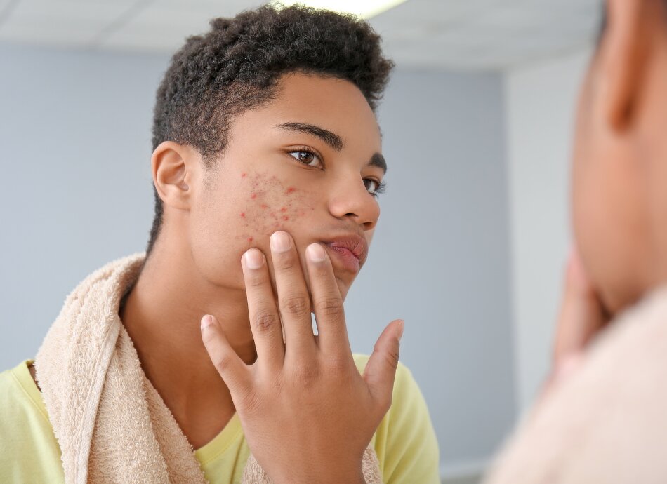 Young man looking at facial acne in mirror