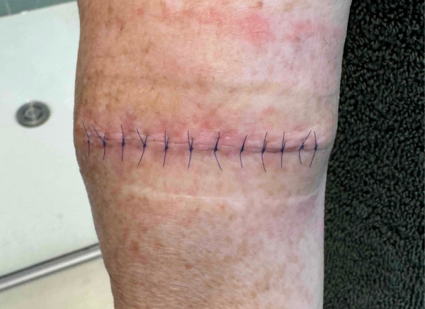 Surgical wound held together with non-dissolvable stitches