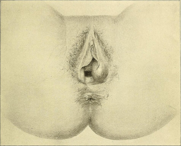 Image of vaginal area showing Bartholin's cyst