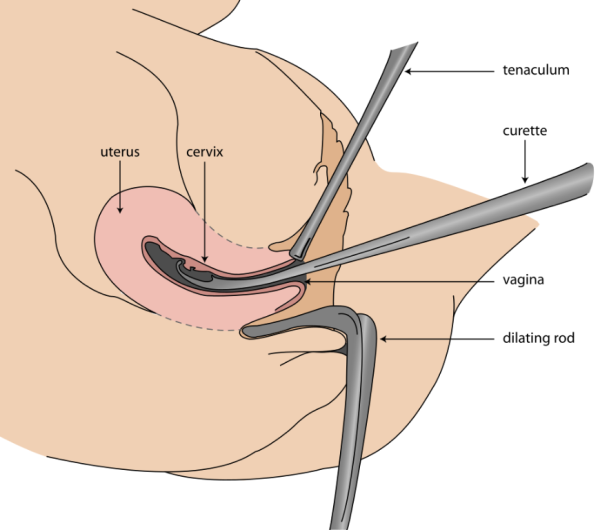 Dilatation and curettage procedure