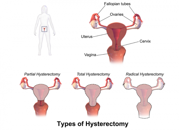 Graphic showing the three types of hysterectomy