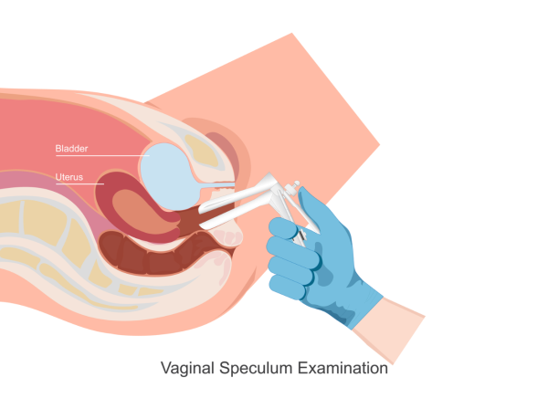 Speculum being used in vaginal exam