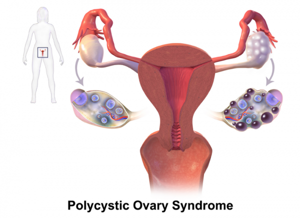 Illustration of normal and polycystic ovaries