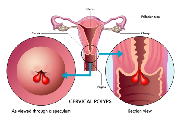 Uterus and cervical polyps
