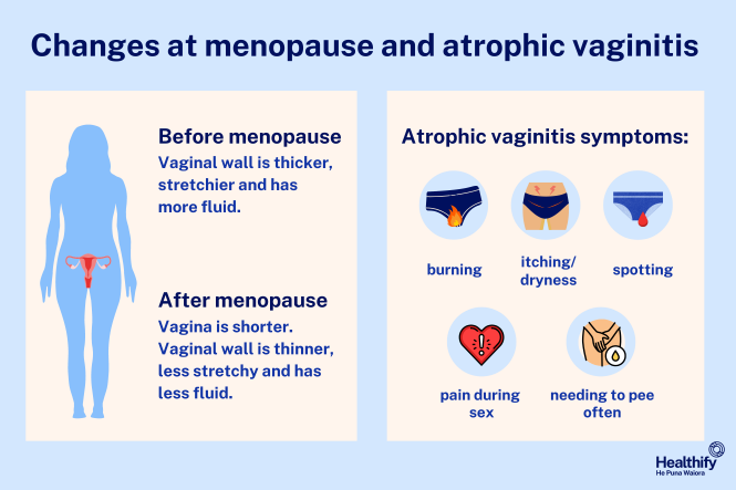 Inforgraphic explaining vaginal changes in menopause and symptoms of atrophic vaginitis