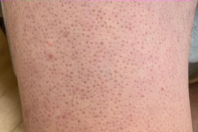 Close up of keratosis pilaris bumps on the lower leg