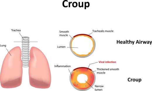 croup diagram