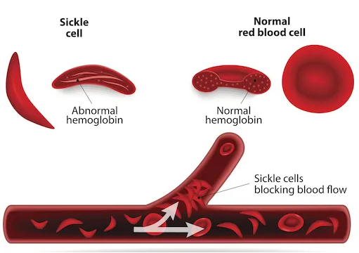 Illustration of sickle cell 