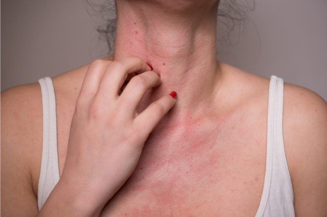 woman scratching red rash on neck