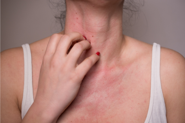 Woman scratching rash on neck