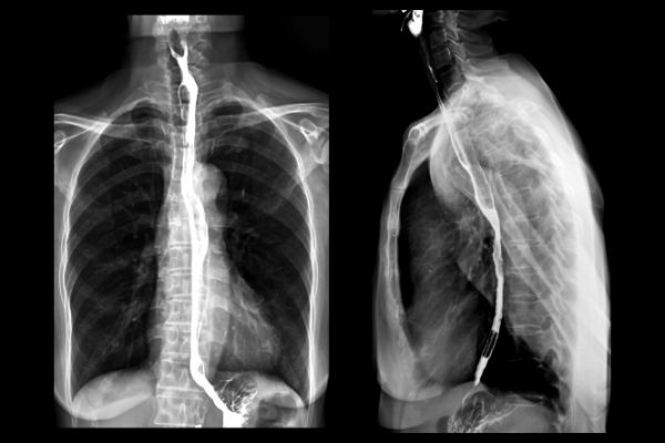 X-ray image of a barium swallow in the oesophagus