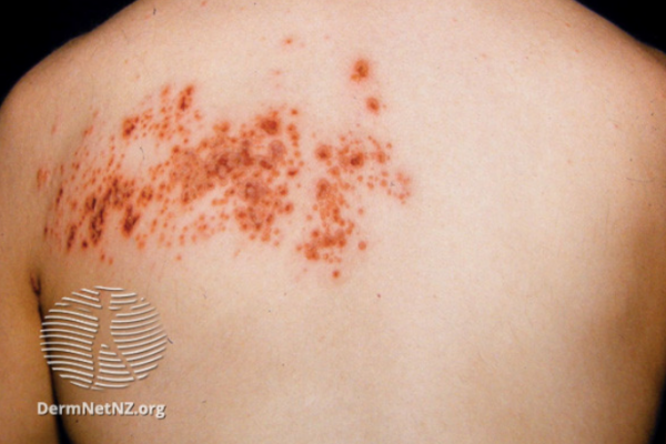 Shingles virus rash across a person's back