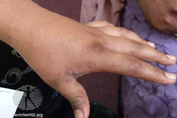 Scabies Rash on Black Skin: Symptoms and Treatment