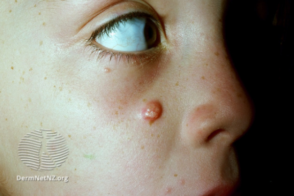 Epidermoid cyst on child's face