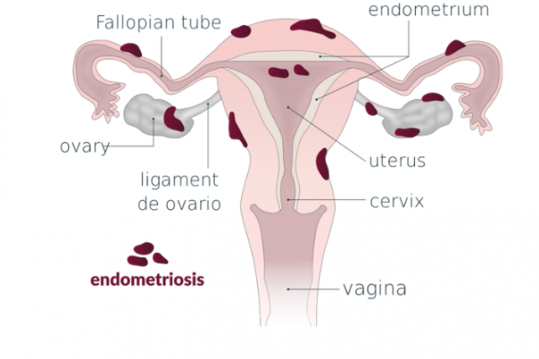 Graphic of female reproductive anatomy showing patches of endometriosis