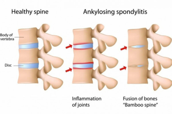 ankylosing spondylitis graphic showing joint inflammation