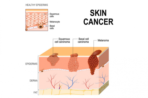 Graphic illustration of skin cancer layers on the epidermis 