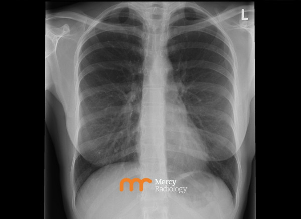 Chest X-ray supplied by Mercy Radiology