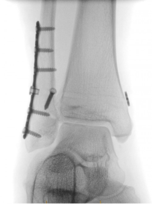 Orthopaedic procedure also using fluoroscopy