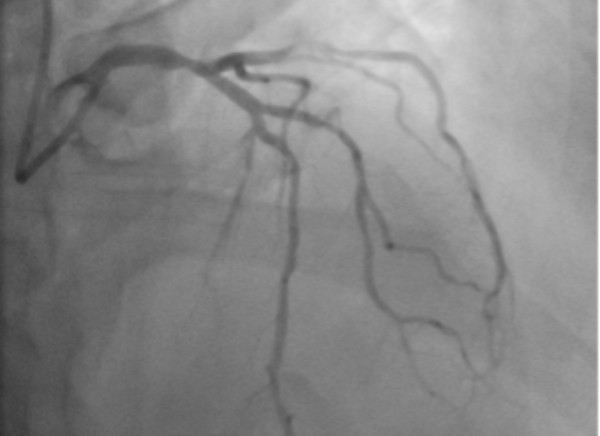 Angiogram of the heart blood vessels