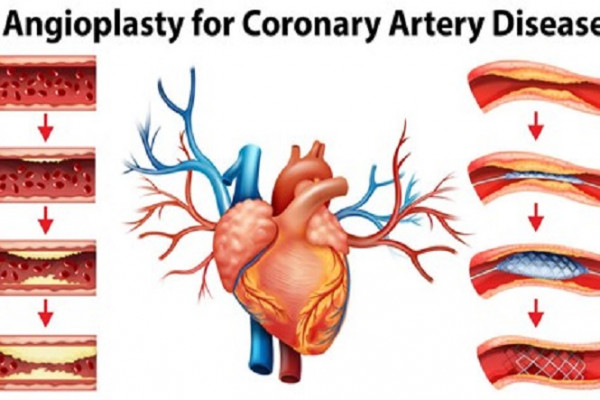 Graphic image of angioplasty for coronary heart disease