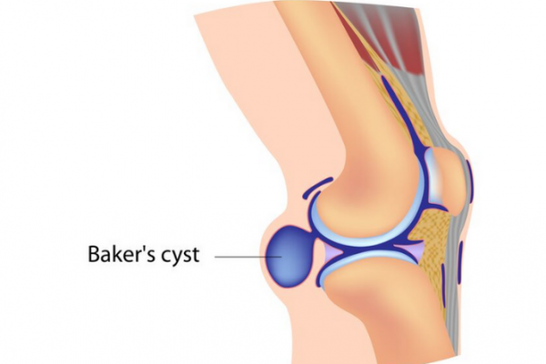 Diagram of knee with Baker's cyst identified
