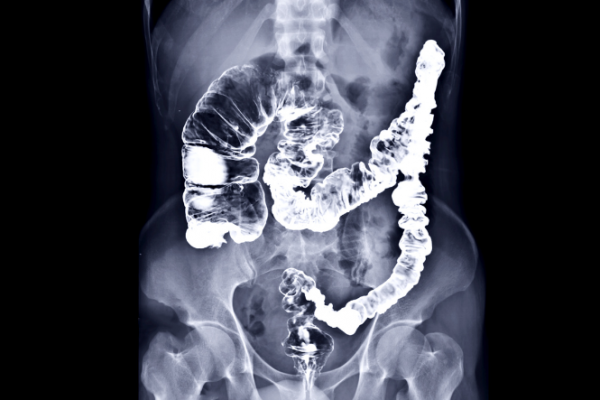X-ray image of colon after barium enema