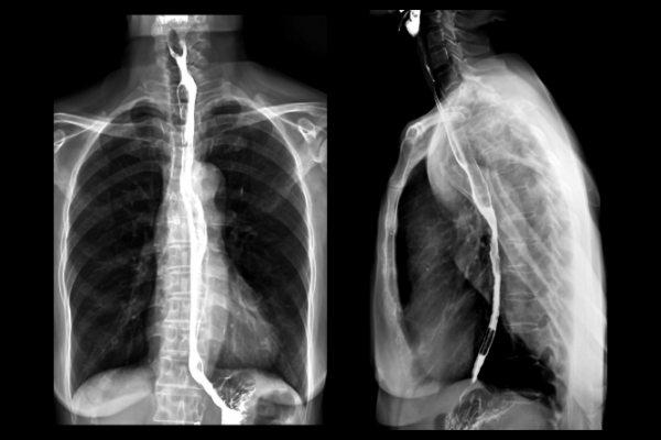 X-ray of chest after barium swallow