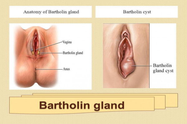 Explicit image of vaginal region showing location of Bartholin glands and a cyst