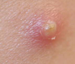 Close up of a skin boil