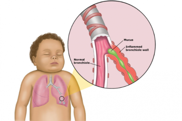 Image of baby's lungs with inset of normal and inflamed bronchioles