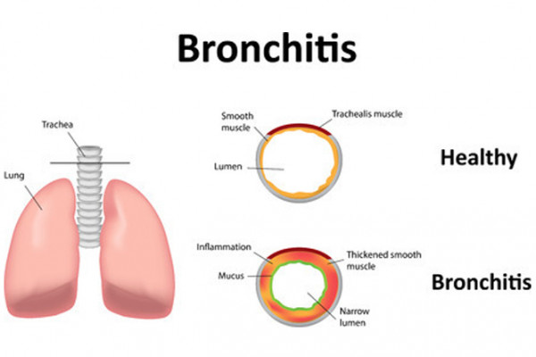 bronchitis causes