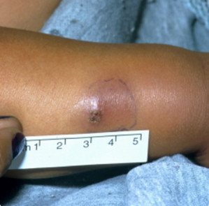 Cellulitis on child's leg with measurement 