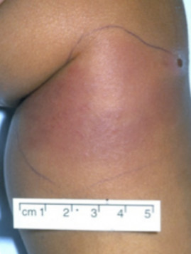 Cellulitis on side of child's leg with measurement