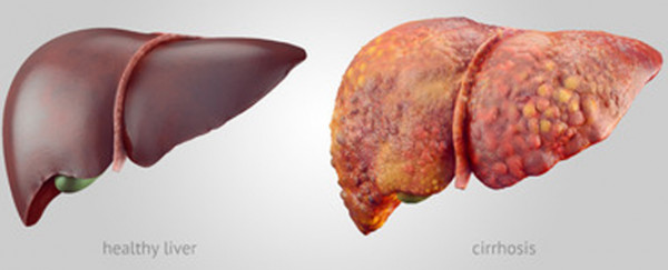 A healthy liver and a liver with cirrhosis