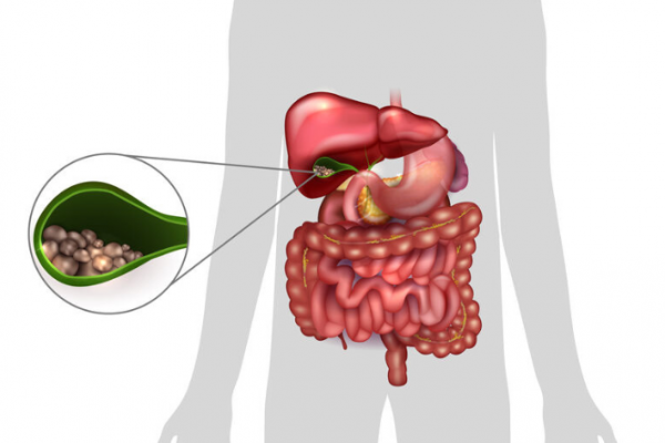 Image showing gallstones in the gallbladder