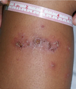 Impetigo or school sores on child's skin with measurement