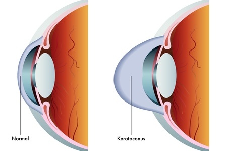 Image of eye showing a normal cornea and one affected by keratoconusnd normal 