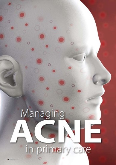 managing acne